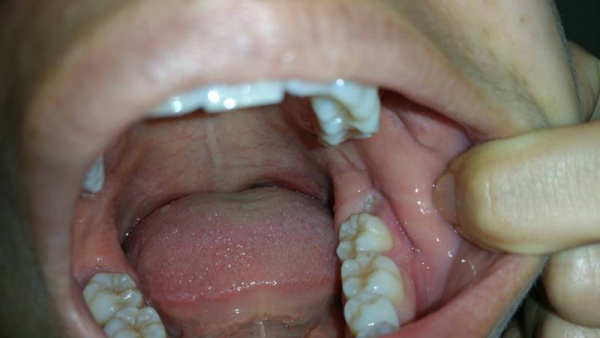 Nhổ răng còn sót chân răng là một tình trạng xảy ra khi răng được nhổ ra nhưng không nảy hết ra khỏi lợi
