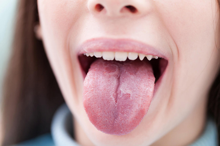 Miệng bị chát là vấn đề phổ biến thường gặp gây khó chịu trong nói chuyện và ăn uống