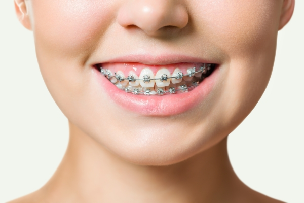 Niềng răng là phương pháp điều trị vị trí răng mọc trong vòm miệng