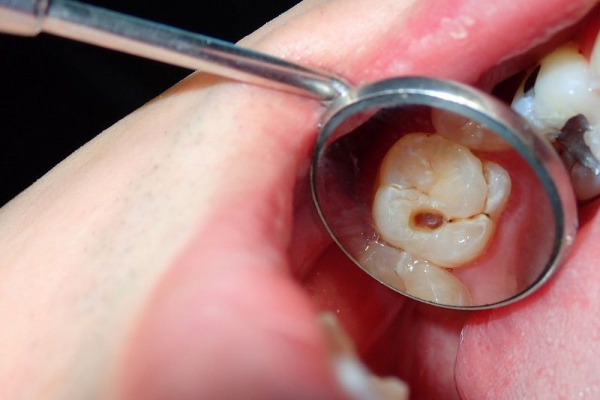 Trám răng tại nhà khá nguy hiểm tiềm ẩn nhiều vấn đề răng miệng không được điều trị tận gốc