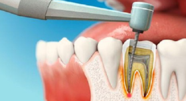 Khi tủy răng bị nhiễm trùng nặng tái diễn liên tục cần phải xem xét đặt thuốc diệt tuỷ