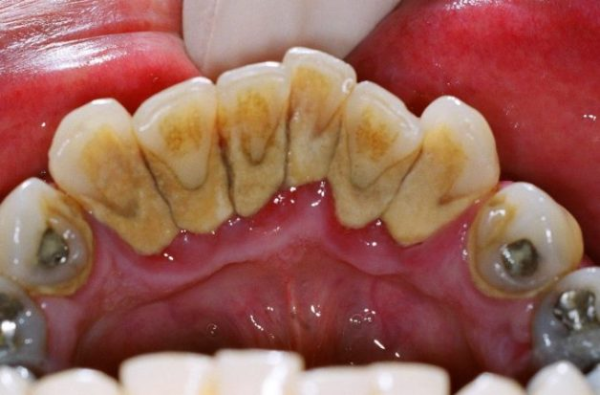 Cao răng tích tụ quá dày đặc là một nguyên nhân dẫn đến tụt lợi