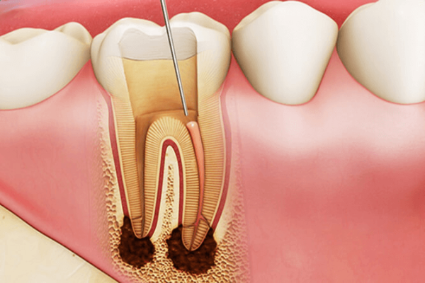 Lấy tủy răng là một phương pháp điều trị để loại bỏ các mảng vi khuẩn và dư chất trong răng, đặc biệt là khi bị nhiễm trùng tủy răng