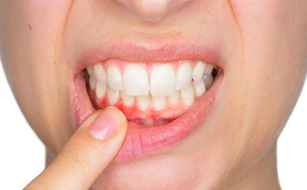 Viêm nướu, viêm lợi và sâu răng là một trong những nguyên nhân gây ra tình trạng tụt lợi