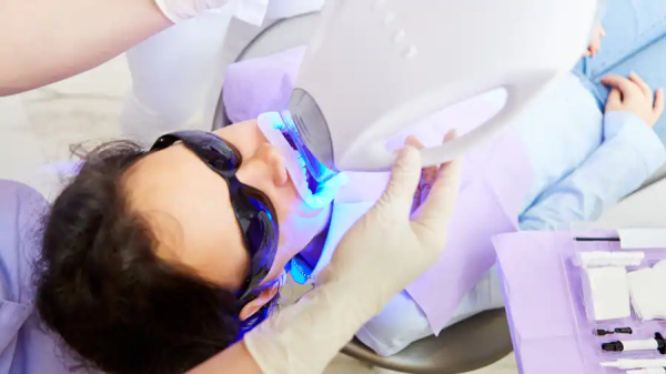 Tẩy trắng răng laser là một phương pháp được sử dụng để loại bỏ các vết ố vàng trên bề mặt răng