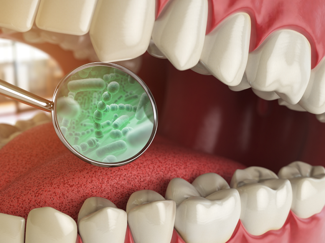 Răng miệng bị nhiễm vi khuẩn, nấm, virus cũng là vấn đề thường gặp bệnh về răng