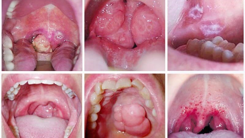 Ung thư vùng miệng là vấn đề rất nghiêm trọng cần gặp bác sĩ kiểm tra và điều trị