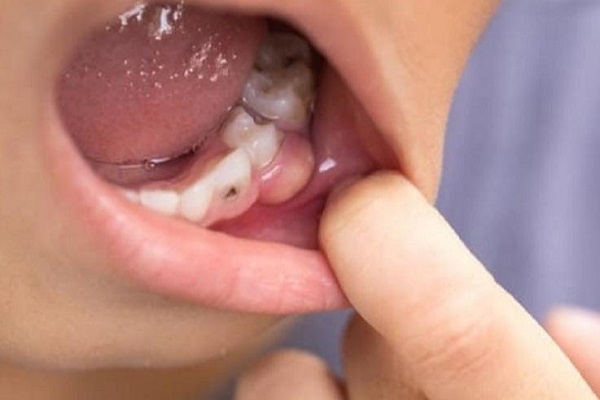 Giải thích nhiễm trùng chân răng