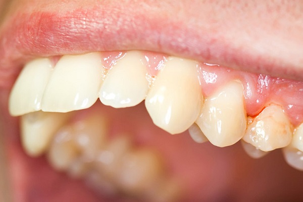 Hậu quả không điều trị nhiễm trùng chân răng