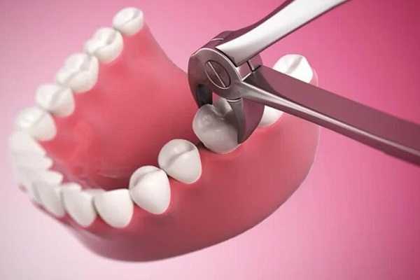 Sử dụng thuốc giảm đau trong quá trình nhổ răng