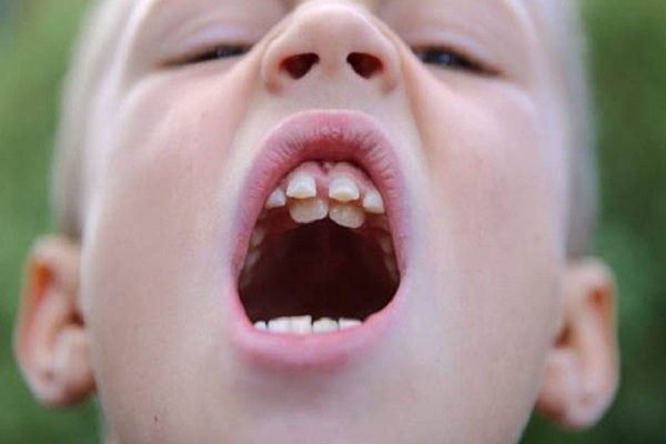 Di truyền gây nên răng mọc lẫy