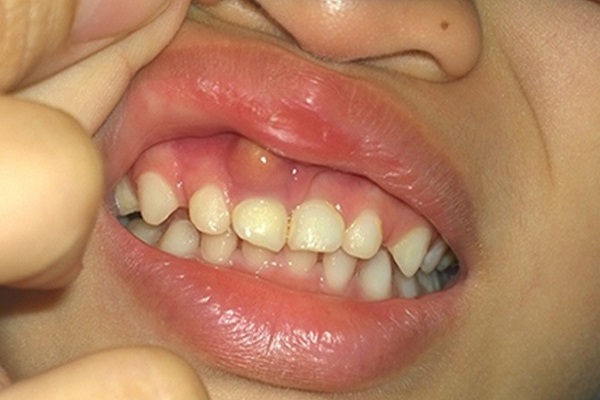 Các dấu hiệu giúp nhận biết nhiễm trùng chân răng