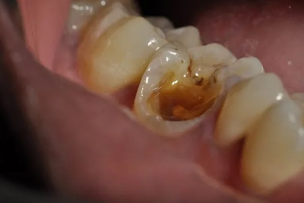 Hệ lụy nguy hiểm khi mất răng số 6