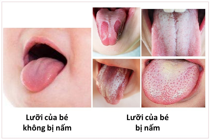 Vệ sinh miệng hằng ngày nước muối ấm giúp phòng ngừa nấm miệng ở trẻ nhỏ