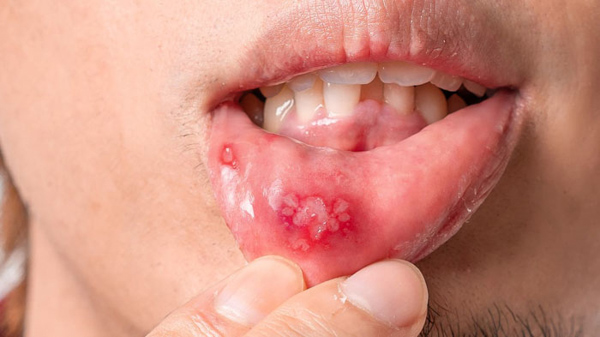 Mụn nước trong miệng có thể nổ và để lại vết loét nhỏ