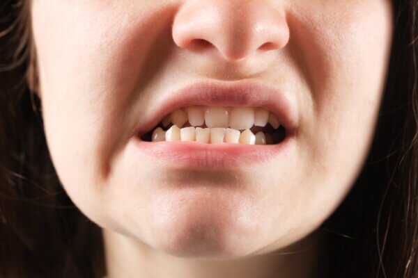 Nghiến răng là một trong những thói quen xấu, có thể khiến quá trình niềng răng gặp thất bại