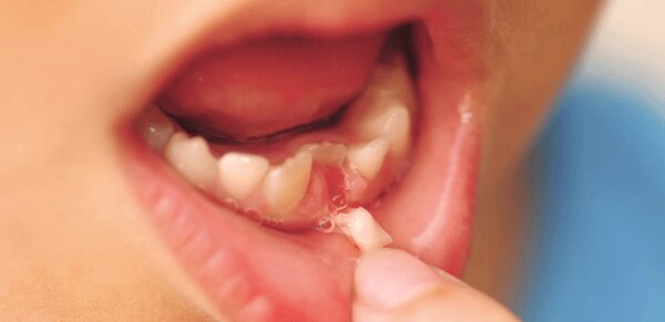 Nhổ răng sữa có đau không?