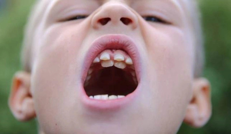 Răng mọc trong vòm miệng là vấn đề thường gặp trong nha khoa