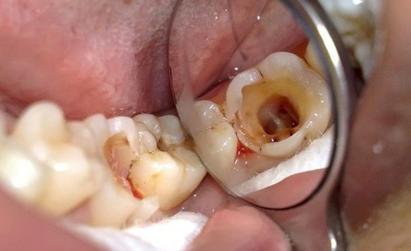 Răng sâu vào tủy là khi vi khuẩn xâm nhập vào phần tủy răng