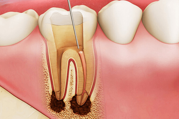 Điều trị loại bỏ một phần tủy răng