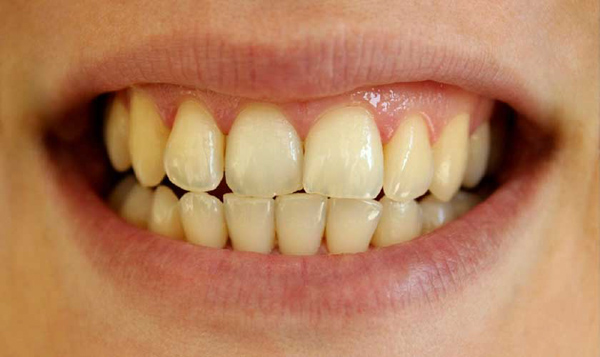 Răng bị ố vàng cũng là một trong những trường hợp nên lắp răng toàn sứ