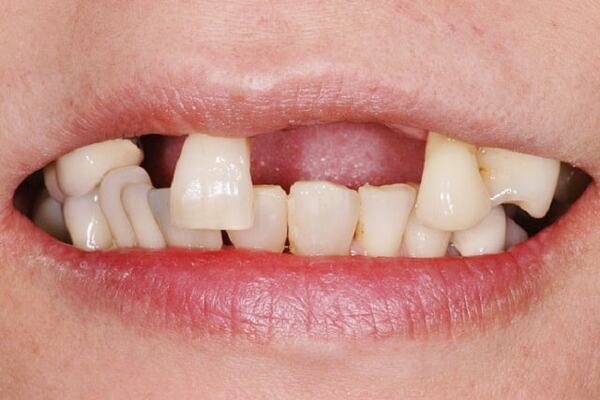 Bọc răng sứ giúp khắc phục răng cửa thưa