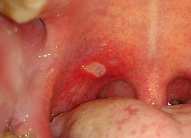Sưng vòm miệng trên là bệnh phổ biến gây khó chịu và đau đớn
