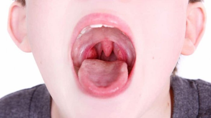 Nguyên nhân sưng vòm miệng trên như tổn thương miệng, nhiễm trùng hay bị dị ứng