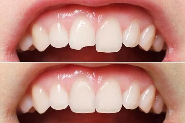 Răng cửa được phục hình hiệu quả, nhanh chóng nhờ phương pháp trám răng