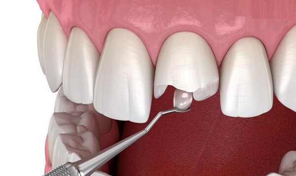 Đi kiểm tra răng định kỳ để bảo đảm sức khoẻ tốt nhất cho răng.