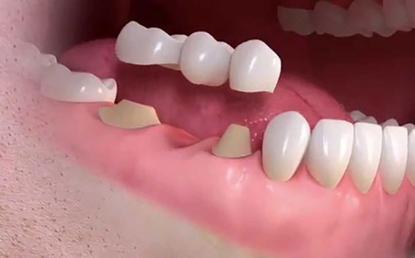 Trồng răng giúp khắc phục vấn đề mất răng, răng móp và chăm sóc răng miệng
