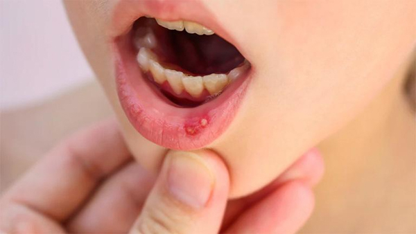 Viêm đỏ niêm mạc miệng là xuất hiện các vết loét và trở nên đỏ sậm