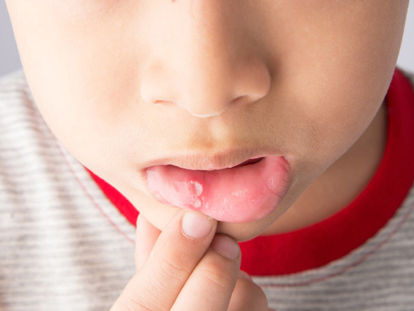 Viêm loét miệng là một bệnh lý phổ biến gặp ở trẻ nhỏ