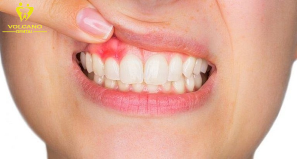 Viêm nha chu, hay còn gọi là viêm nướu, là một vấn đề phổ biến về răng miệng