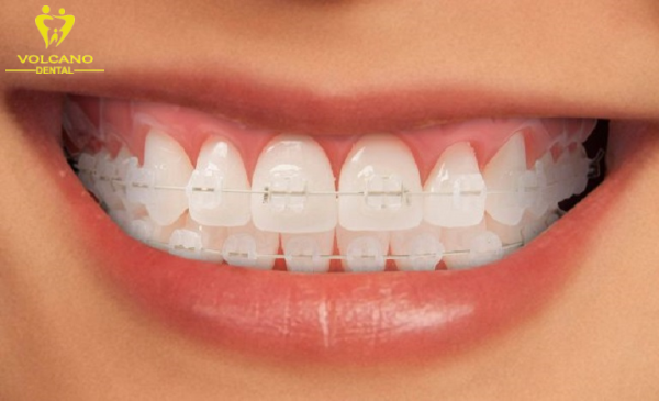 Niềng răng mắc cài sứ, pha lê là một phương pháp niềng răng cho trẻ 16 tuổi