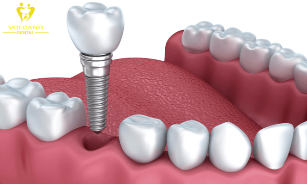 Cấy ghép implant là một phương pháp hiện đại giúp khắc phục răng lung lay