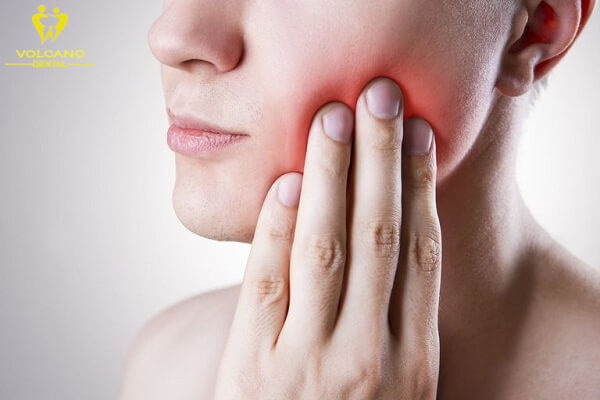 Đau và sưng là điều bình thường và sẽ kéo dài trong vài ngày sau khi phẫu thuật nhổ răng khôn