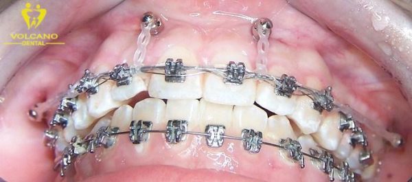 Đánh lún răng, còn được gọi là hiệu chỉnh chỗ răng hay đánh răng sâu