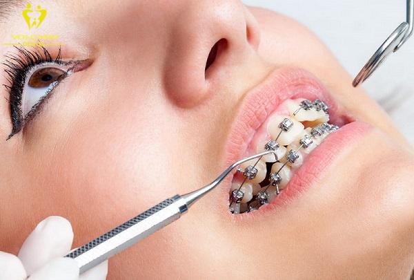 Phương pháp đánh lún răng phổ biến hiện nay