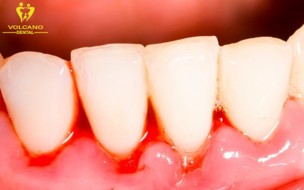 Uống thuốc gì khi bị đau răng do chấn thương?