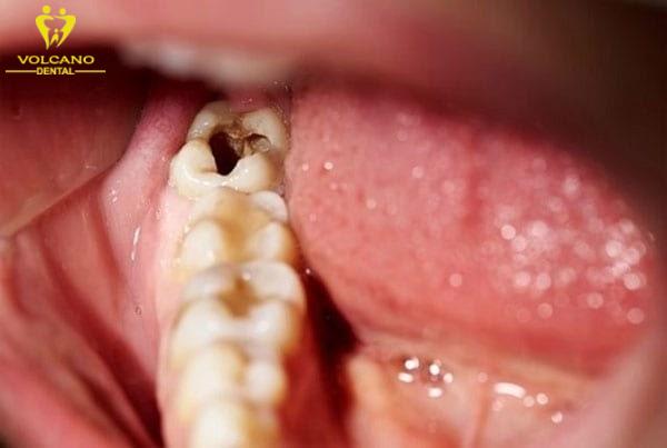Sâu răng là một nguyên nhân gây đau răng