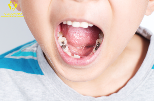Sâu răng là một vấn đề thường gặp ở trẻ em