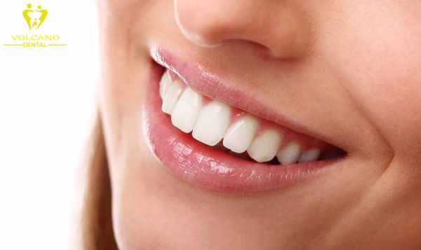 Bọc sứ thẩm mỹ không chỉ khắc phục mẻ răng mà còn cải thiện vẻ ngoài của nụ cười