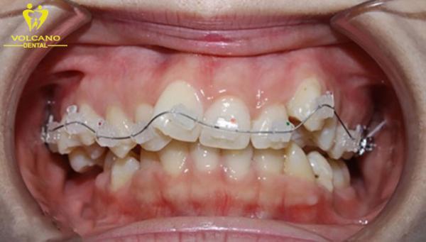 Nhiều người lựa chọn niềng răng để khắc phục răng mọc ngược