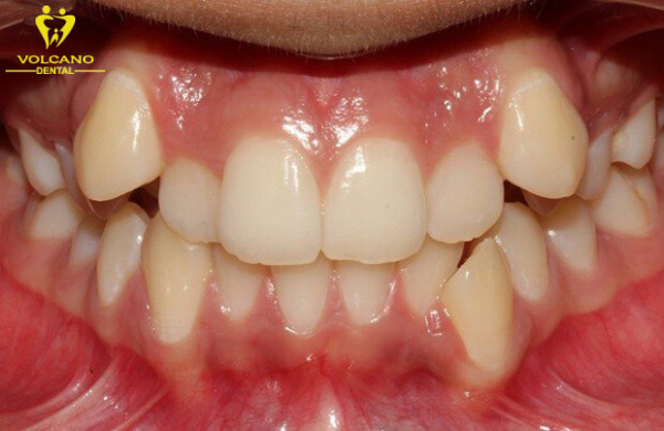 Răng mọc không đều là tình trạng mà các răng không nằm đúng vị trí, tạo thành hàm răng không đều và không cân đối