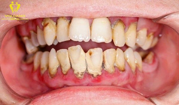 Răng bị đen ở kẽ gây ra không ít phiền toái và tự ti trong việc giao tiếp và cười