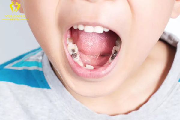 bé 5 tuổi bị sâu răng hàm phải làm sao?