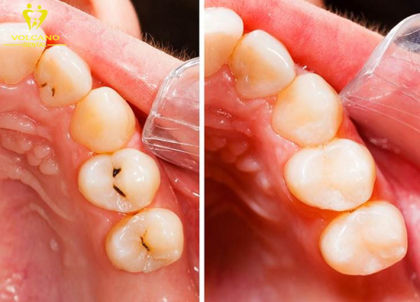 Sâu răng hàm trong giai đoạn đầu (mức độ nhẹ)