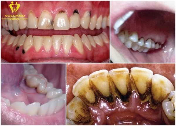 Đốm đen trên răng cửa, răng hàm, mùi hôi miệng là các triệu chứng khi răng bị đen ở kẽ