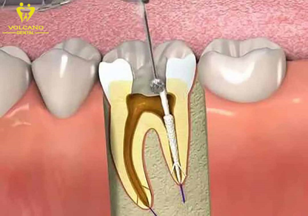 Quy trình lấy chỉ máu răng thường không gây đau đớn đáng kể